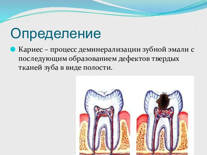 Определение Кариес – процесс деминерализации зубной эмали с последующим образованием дефектов твердых