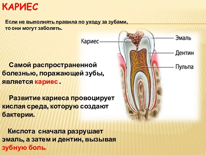 КАРИЕС Самой распространенной болезнью, поражающей зубы, является кариес . Развитие кариеса провоцирует