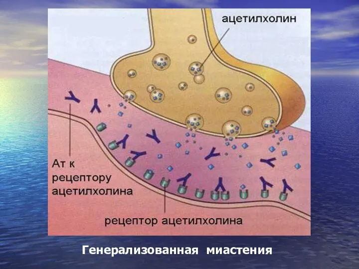 Генерализованная миастения