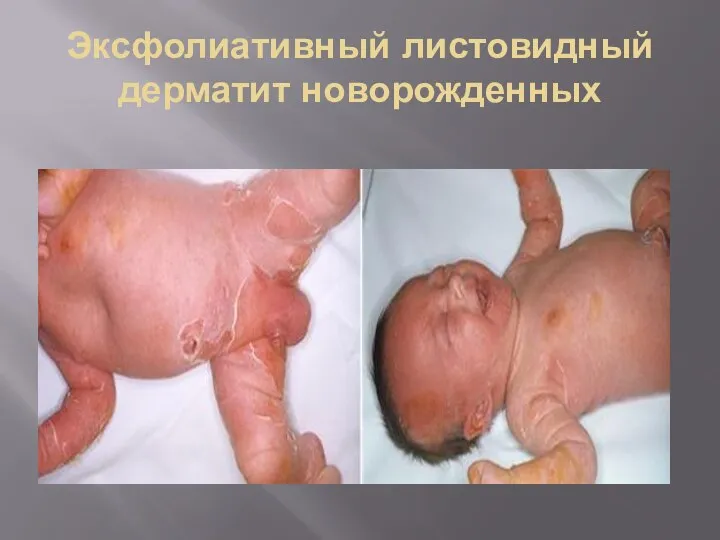 Эксфолиативный листовидный дерматит новорожденных
