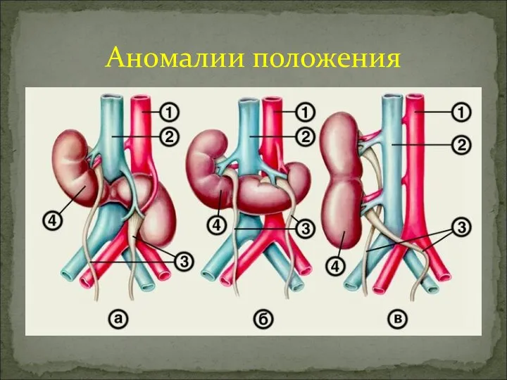 Аномалии положения