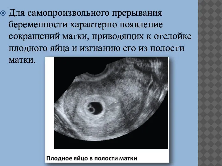 Для самопроизвольного прерывания беременности характерно появление сокращений матки, приводящих к отслойке плодного