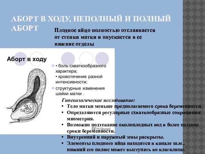 АБОРТ В ХОДУ, НЕПОЛНЫЙ И ПОЛНЫЙ АБОРТ Плодное яйцо полностью отслаивается от