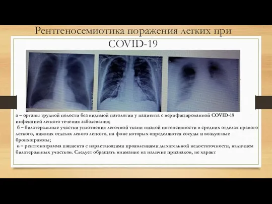 Рентгеносемиотика поражения легких при COVID-19 а – органы грудной полости без видимой