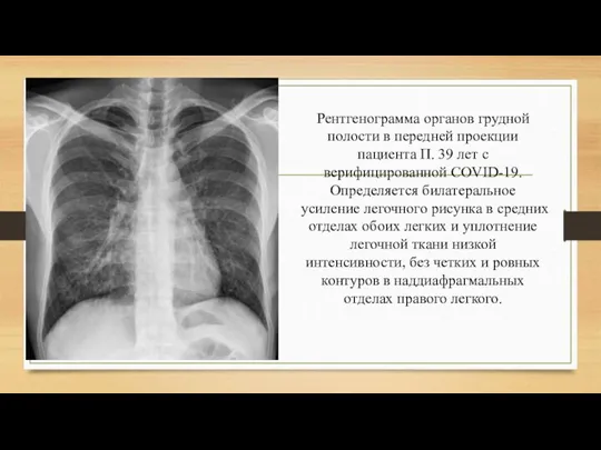 Рентгенограмма органов грудной полости в передней проекции пациента П. 39 лет с