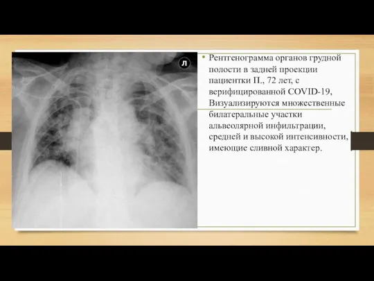 Рентгенограмма органов грудной полости в задней проекции пациентки П., 72 лет, с