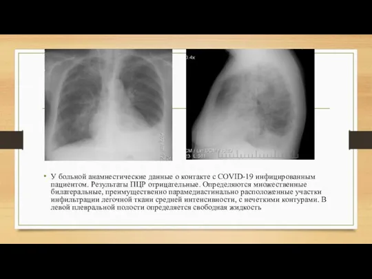 У больной анамнестические данные о контакте с COVID-19 инфицированным пациентом. Результаты ПЦР