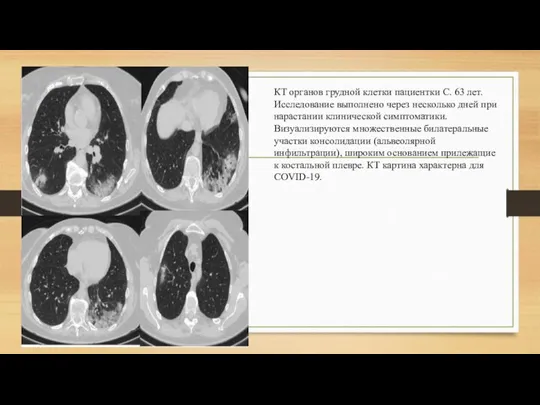 КТ органов грудной клетки пациентки С. 63 лет. Исследование выполнено через несколько