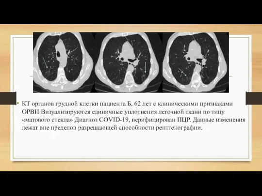 КТ органов грудной клетки пациента Б, 62 лет с клиническими признаками ОРВИ