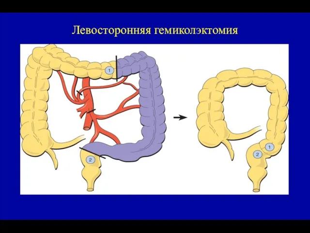 Левосторонняя гемиколэктомия