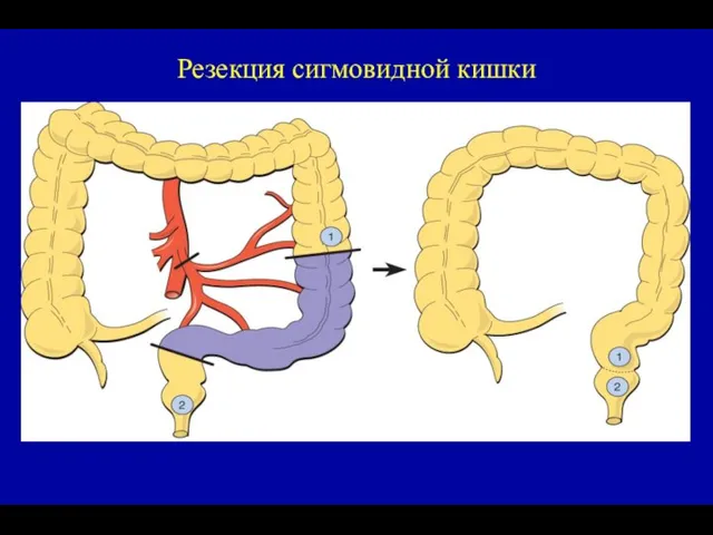 Резекция сигмовидной кишки