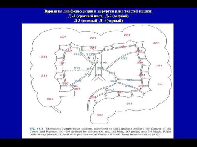 Варианты лимфодиссекции в хирургии рака толстой кишки: Д -1 (красный цвет) Д-2
