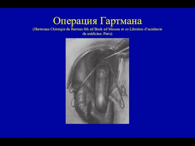 Операция Гартмана (Hartmann Chirurgie du Rectum 8th ed Book ed Masson et