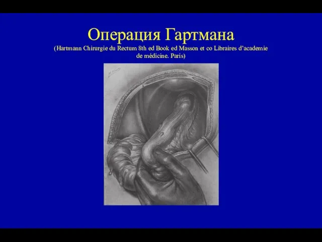 Операция Гартмана (Hartmann Chirurgie du Rectum 8th ed Book ed Masson et