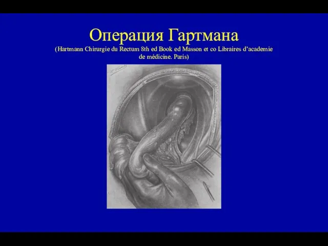 Операция Гартмана (Hartmann Chirurgie du Rectum 8th ed Book ed Masson et