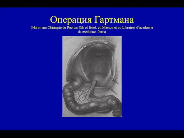 Операция Гартмана (Hartmann Chirurgie du Rectum 8th ed Book ed Masson et