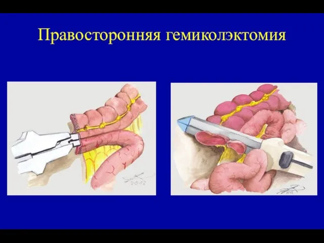 Правосторонняя гемиколэктомия