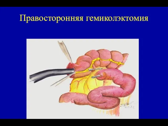 Правосторонняя гемиколэктомия