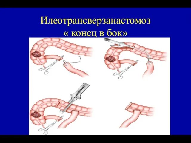 Илеотрансверзанастомоз « конец в бок»