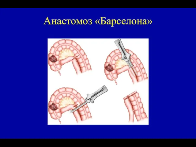 Анастомоз «Барселона»