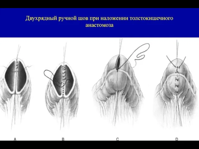 Двухрядный ручной шов при наложении толстокишечного анастомоза