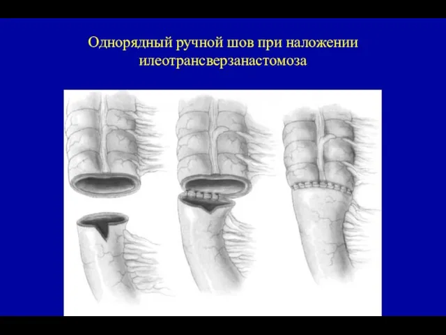 Однорядный ручной шов при наложении илеотрансверзанастомоза