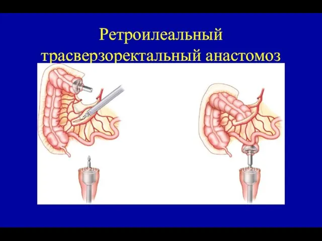 Ретроилеальный трасверзоректальный анастомоз