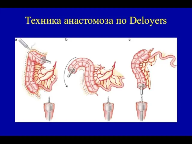 Техника анастомоза по Deloyers