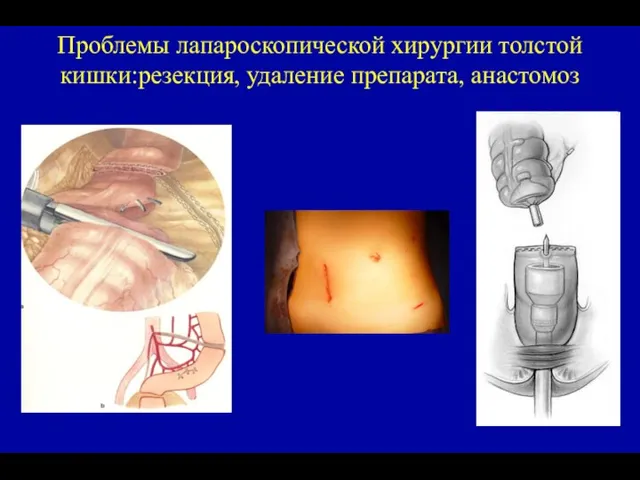 Проблемы лапароскопической хирургии толстой кишки:резекция, удаление препарата, анастомоз