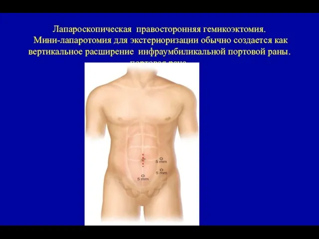 Лапароскопическая правосторонняя гемикоэктомия. Мини-лапаротомия для экстериоризации обычно создается как вертикальное расширение инфраумбиликальной портовой раны. портовая рана.