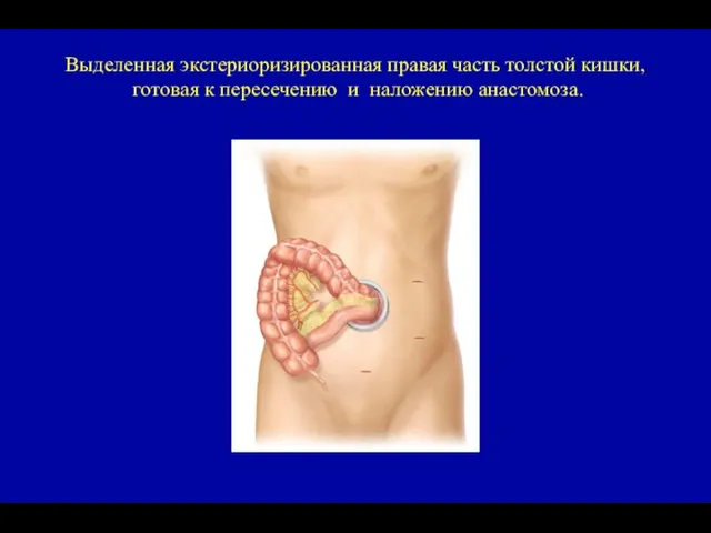 Выделенная экстериоризированная правая часть толстой кишки, готовая к пересечению и наложению анастомоза.