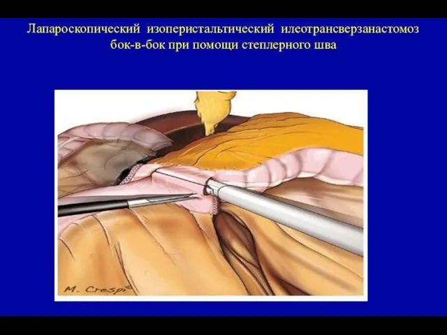 Лапароскопический изоперистальтический илеотрансверзанастомоз бок-в-бок при помощи степлерного шва