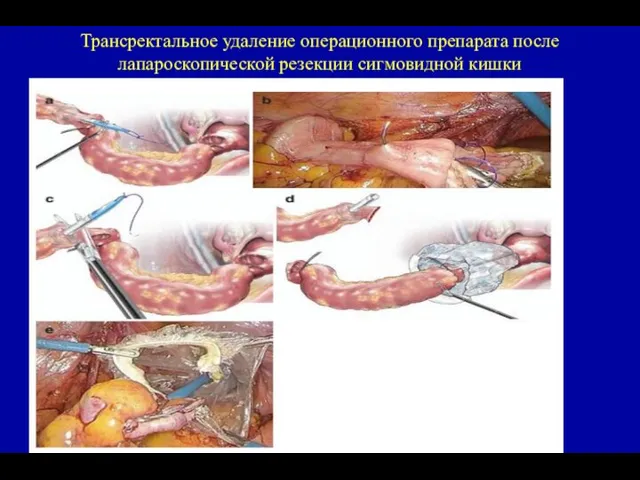 Трансректальное удаление операционного препарата после лапароскопической резекции сигмовидной кишки