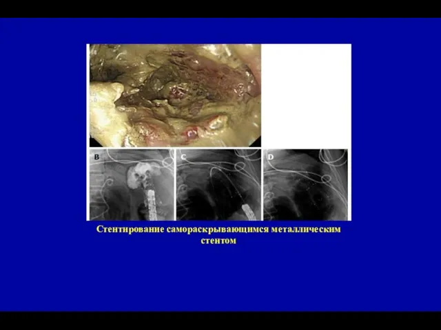 Стентирование самораскрывающимся металлическим стентом
