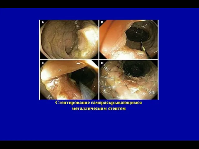 Стентирование самораскрывающимся металлическим стентом