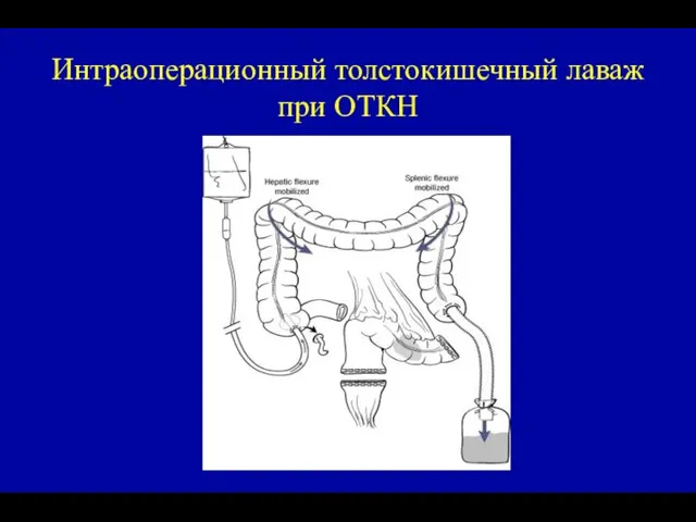 Интраоперационный толстокишечный лаваж при ОТКН