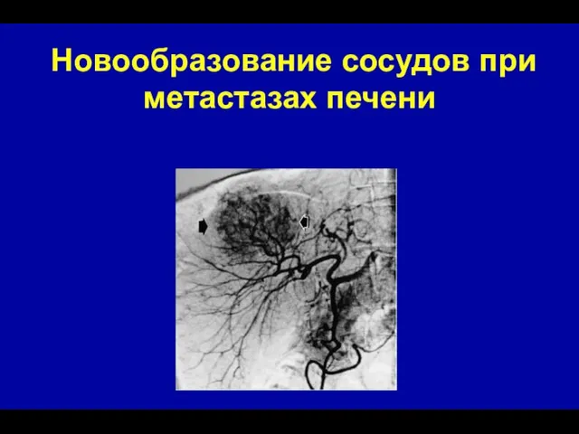 Новообразование сосудов при метастазах печени