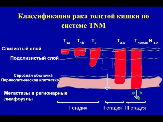 Классификация рака толстой кишки по системе TNM Слизистый слой Серозная оболочка Параколитическая