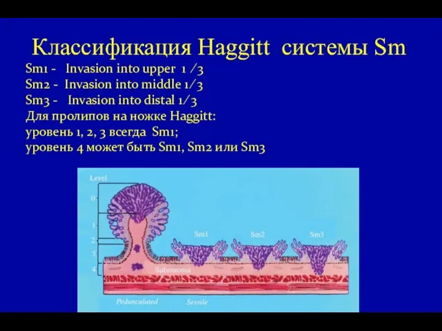 Классификация Haggitt системы Sm Sm1 - Invasion into upper 1 ⁄ 3