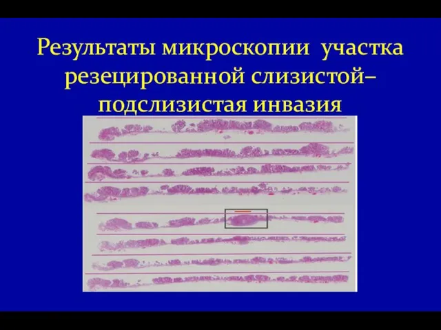 Результаты микроскопии участка резецированной слизистой– подслизистая инвазия