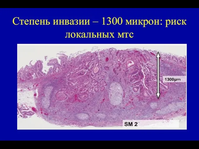 Степень инвазии – 1300 микрон: риск локальных мтс