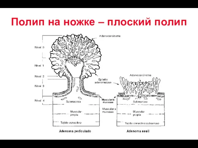 Полип на ножке – плоский полип