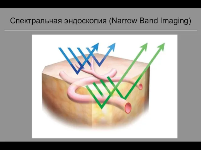 Спектральная эндоскопия (Narrow Band Imaging)