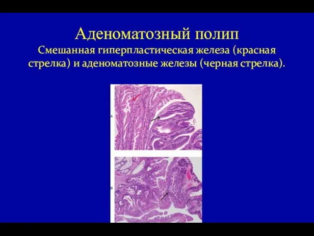 Аденоматозный полип Смешанная гиперпластическая железа (красная стрелка) и аденоматозные железы (черная стрелка).