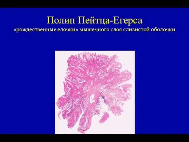 Полип Пейтца-Егерса «рождественные елочки» мышечного слоя слизистой оболочки