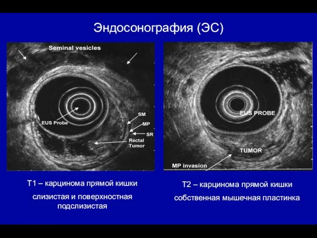 T1 – карцинома прямой кишки слизистая и поверхностная подслизистая T2 – карцинома