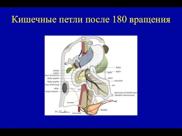 Кишечные петли после 180 вращения