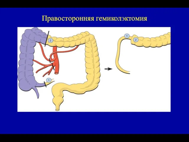 Правосторонняя гемиколэктомия