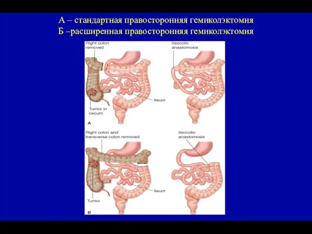 А – стандартная правосторонняя гемиколэктомия Б –расширенная правосторонняя гемиколэктомия