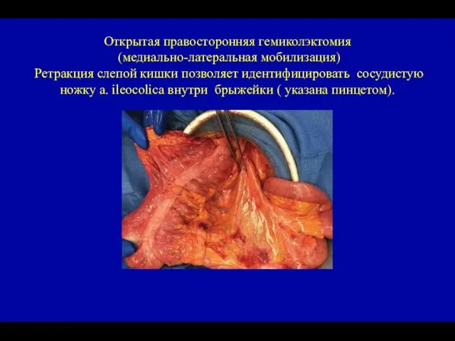 Открытая правосторонняя гемиколэктомия (медиально-латеральная мобилизация) Ретракция слепой кишки позволяет идентифицировать сосудистую ножку